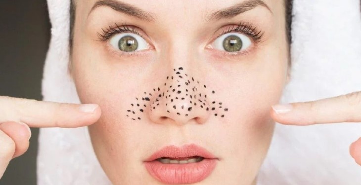 Що таке комедони: причини появи і як з ними боротися ефективно