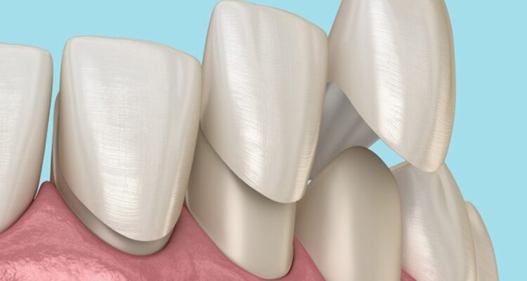 Композитні вініри: що це таке та як вони покращують вашу усмішку?