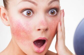 Зрозумійте купероз: причини, симптоми та ефективні методи лікування