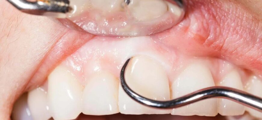 Кюретаж у стоматології: повний огляд та важливі нюанси процедури Кюретаж у стоматології: повний огляд та важливі нюанси процедури