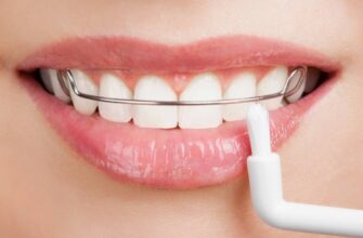 “Ретейнери: Що це таке і чому вони важливі для вашої усмішки?”