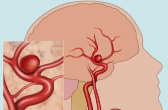 Що таке аневризма: особливості, причини та методи діагностики