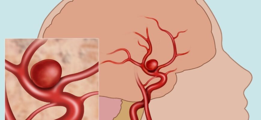 Що таке аневризма: особливості, причини та методи діагностики