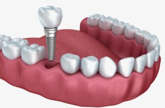 Імпланти: Що це таке, види та переваги для вашого здоров’я
