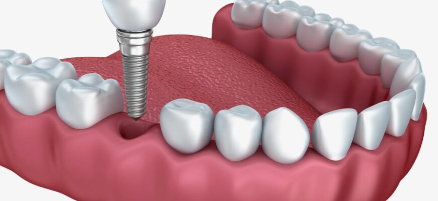 Імпланти: Що це таке, види та переваги для вашого здоров’я