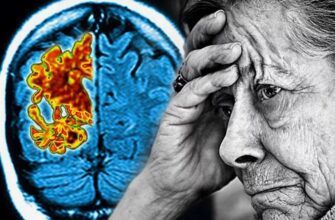 Хвороба Альцгеймера: симптоми, причини та сучасні методи лікування