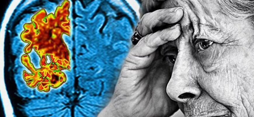 Хвороба Альцгеймера: симптоми, причини та сучасні методи лікування