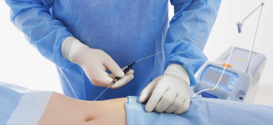 Що таке ліпосакція: докладний гід з методами та ризиками процедури