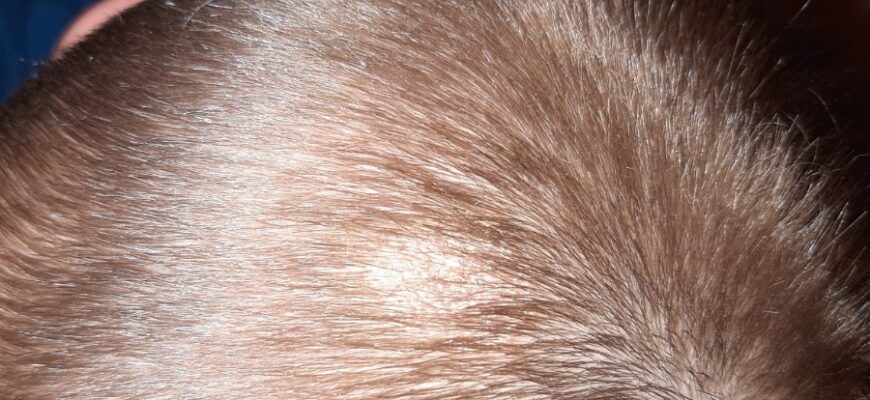 Що таке лишай: причини, симптоми та методи лікування захворювання Що таке лишай: причини, симптоми та методи лікування захворювання