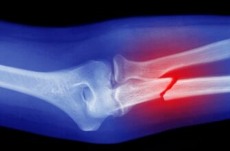 Що таке перелом: визначення, види та перша допомога при травмах