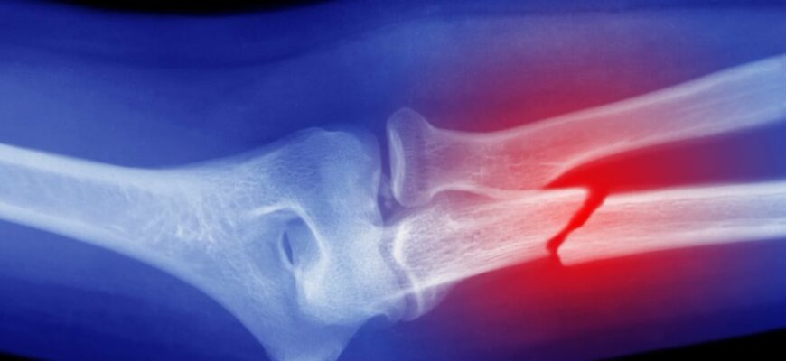 Що таке перелом: визначення, види та перша допомога при травмах