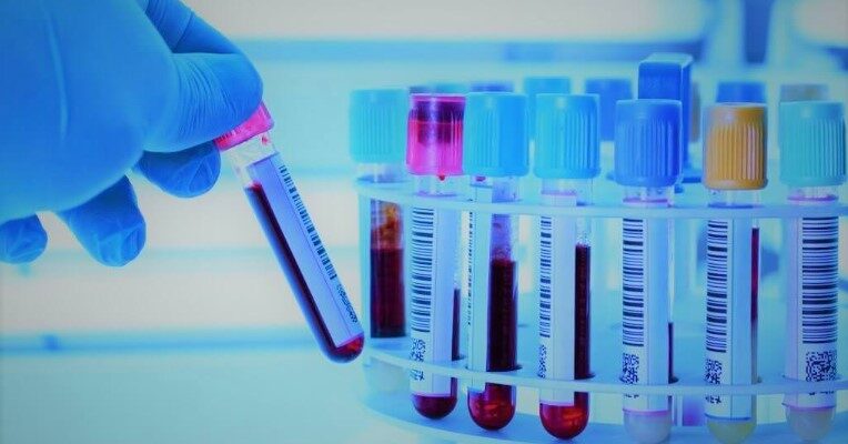 Швидкість осідання еритроцитів (ШОЕ): значення та вплив на здоров’я