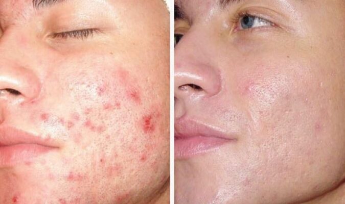 Карбоновий пілінг: сучасний метод очищення та омолодження шкіри Карбоновий пілінг: сучасний метод очищення та омолодження шкіри