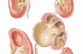 Що таке калікоектазія: причини, симптоми та способи лікування