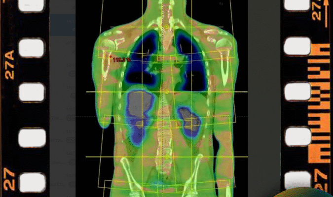 Денситометрія: Що Це Таке І Як Вона Допомагає Здоров’ю Кісток? Денситометрія: Що Це Таке І Як Вона Допомагає Здоров’ю Кісток?