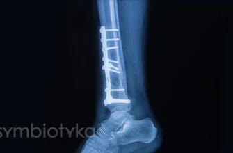 Остеосинтез: сучасні методи відновлення кісткових тканин в Україні