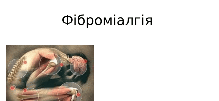 Фіброміалгія: симптоми, діагностика та ефективні методи лікування Фіброміалгія: симптоми, діагностика та ефективні методи лікування