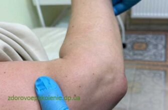 Бурсит: Що Це Таке, Причини, Симптоми Та Методи Лікування