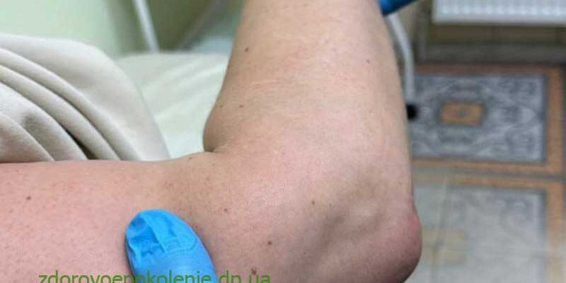 Бурсит: Що Це Таке, Причини, Симптоми Та Методи Лікування