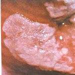 Лейкоплакія шийки матки: причини, симптоми та сучасні методи лікування