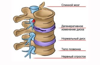 Дорсопатія: основні причини, симптоми та методи лікування хвороби