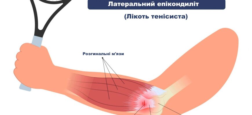 Епікондиліт: Причини, Симптоми та Ефективні Методики Лікування