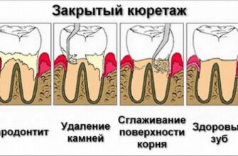 Кюретаж зубів: що це таке та чому важливо для здоров’я ясен?