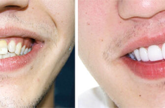 Люмінири: ідеальне рішення для сяючої посмішки без хірургії