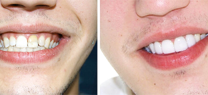 Люмінири: ідеальне рішення для сяючої посмішки без хірургії Люмінири: ідеальне рішення для сяючої посмішки без хірургії