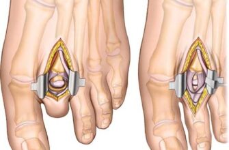 Неврома Мортона: симптоми, причини та ефективні методи лікування