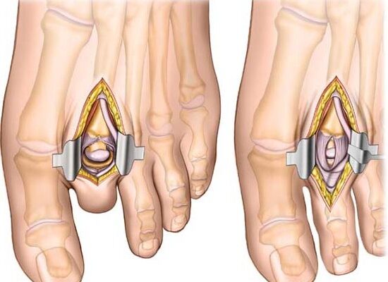 Неврома Мортона: симптоми, причини та ефективні методи лікування