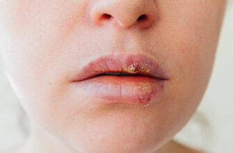 Вірус Епштейна-Барр: основна інформація, симптоми та лікування