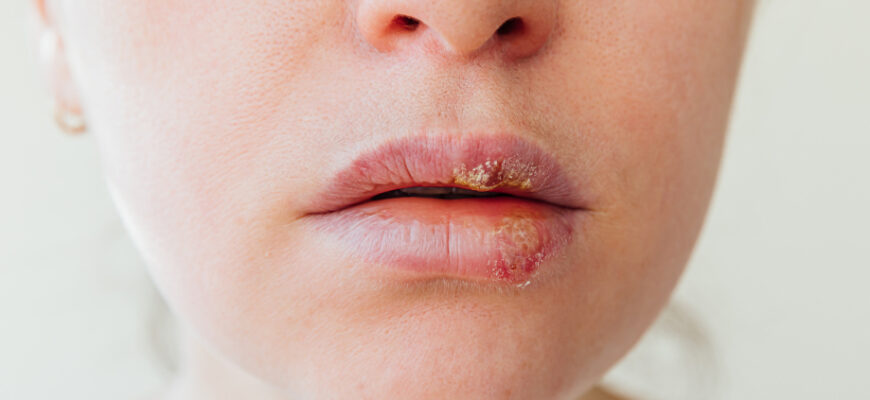 Вірус Епштейна-Барр: основна інформація, симптоми та лікування Вірус Епштейна-Барр: основна інформація, симптоми та лікування