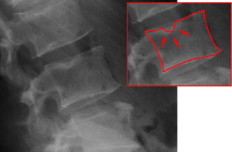 Шморля вузли: від чого виникають та які наслідки для здоров’я