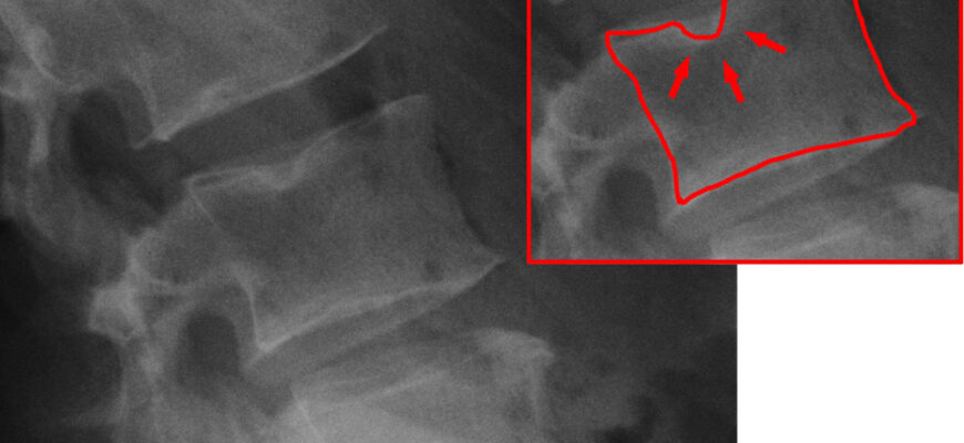 Шморля вузли: від чого виникають та які наслідки для здоров’я