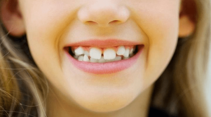 Діастема: причини, наслідки та способи усунення зубної щілини