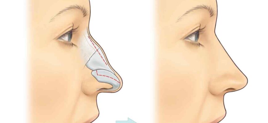 Риносептопластика: Все, що потрібно знати про операцію на носі