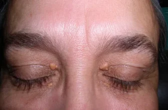 Ксантелазма: як розпізнати, причини виникнення та методи лікування