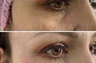 Які ін’єкції ефективно усувають темні кола під очима: повний гід