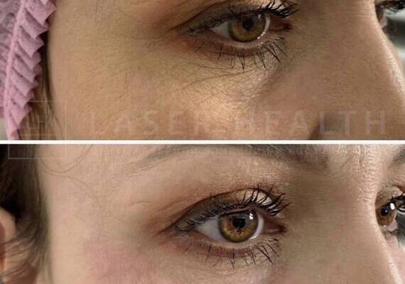 Які ін’єкції ефективно усувають темні кола під очима: повний гід