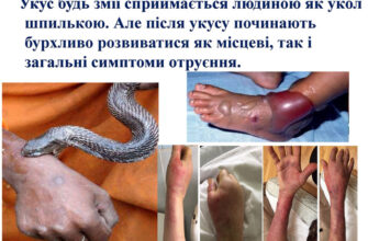 Що відчуває людина після укусу отруйної змії: основні симптоми та наслідки