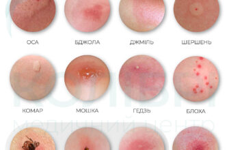 “Як розпізнати алергію на укуси комарів: основні симптоми та ознаки”