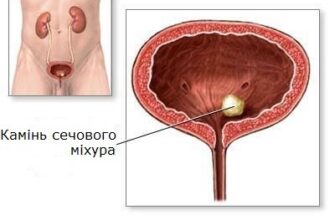 Тривалість виходу каменю з сечового міхура: скільки часу це займе?