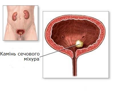 Тривалість виходу каменю з сечового міхура: скільки часу це займе?