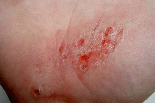 Чи можна мочити скоринку від рани: поради для швидкого загоєння