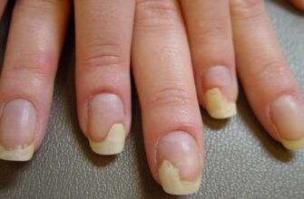 Оніхолізис від гель-лаку: основні причини та способи захисту нігтів