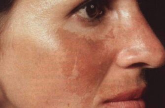 Чи варто щодня використовувати перекис водню для догляду за шкірою?