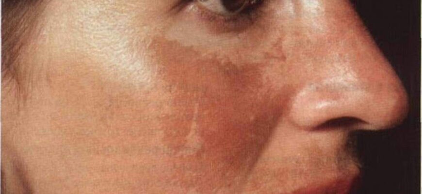 Чи варто щодня використовувати перекис водню для догляду за шкірою?