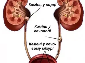 Як визначити наявність сечових каменів: симптоми та поради лікарів