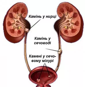 Як визначити наявність сечових каменів: симптоми та поради лікарів